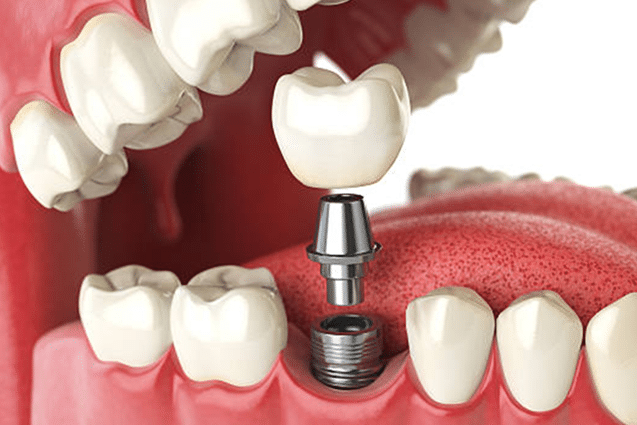 dental implants melbourne