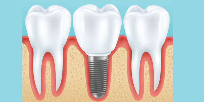 dental implants melbourne